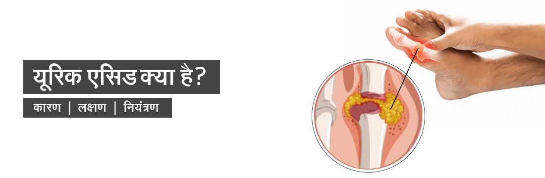  Uric Acid in Hindi यूरिक एसिड: कारण, लक्षण और नियंत्रण - सभी जानकारी